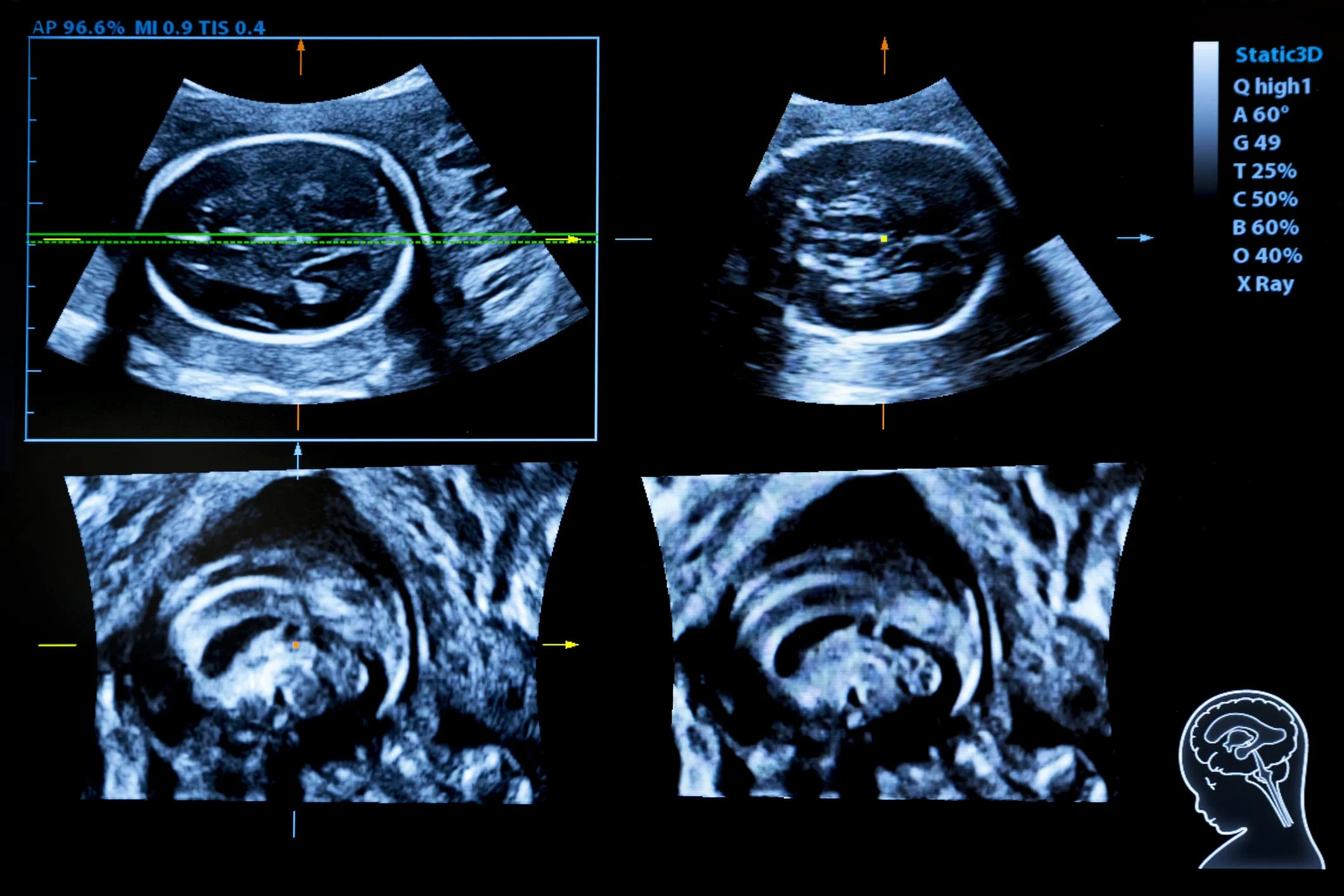 Pantalla de diagnóstico médico que muestra una neurosonografía fetal con cuatro planos de corte detallados del cerebro del bebé en alta resolución, permitiendo observar las estructuras intracraneales.