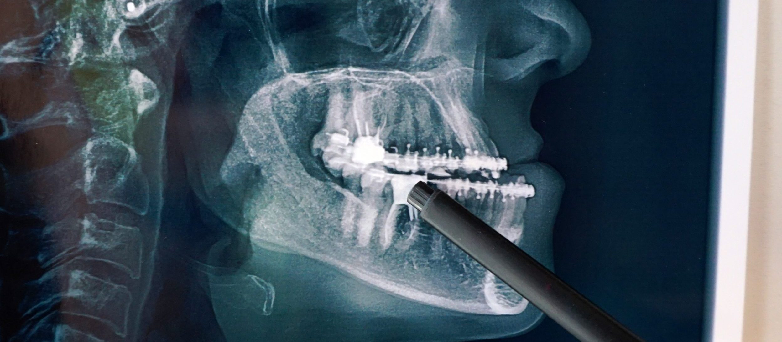 ¿Cuál es la diferencia entre cirugía maxilofacial y cirugía oral?