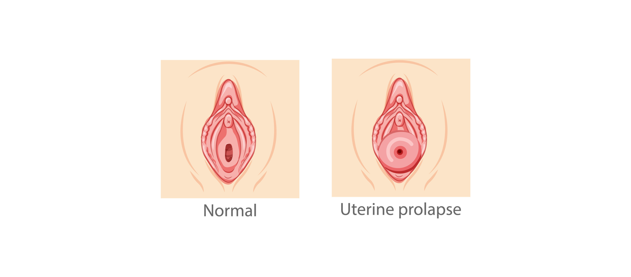 Prolapso uterino