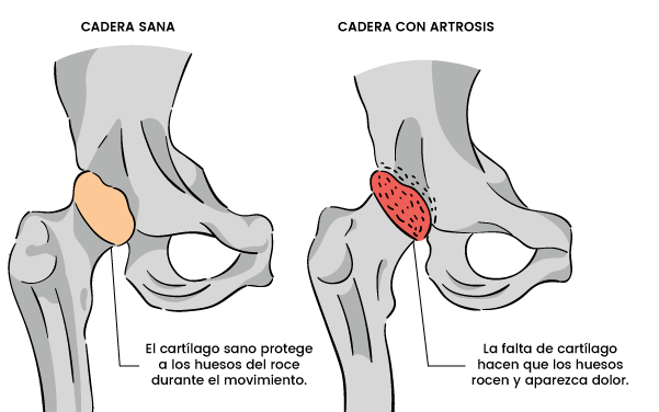 Artrosis en la cadera