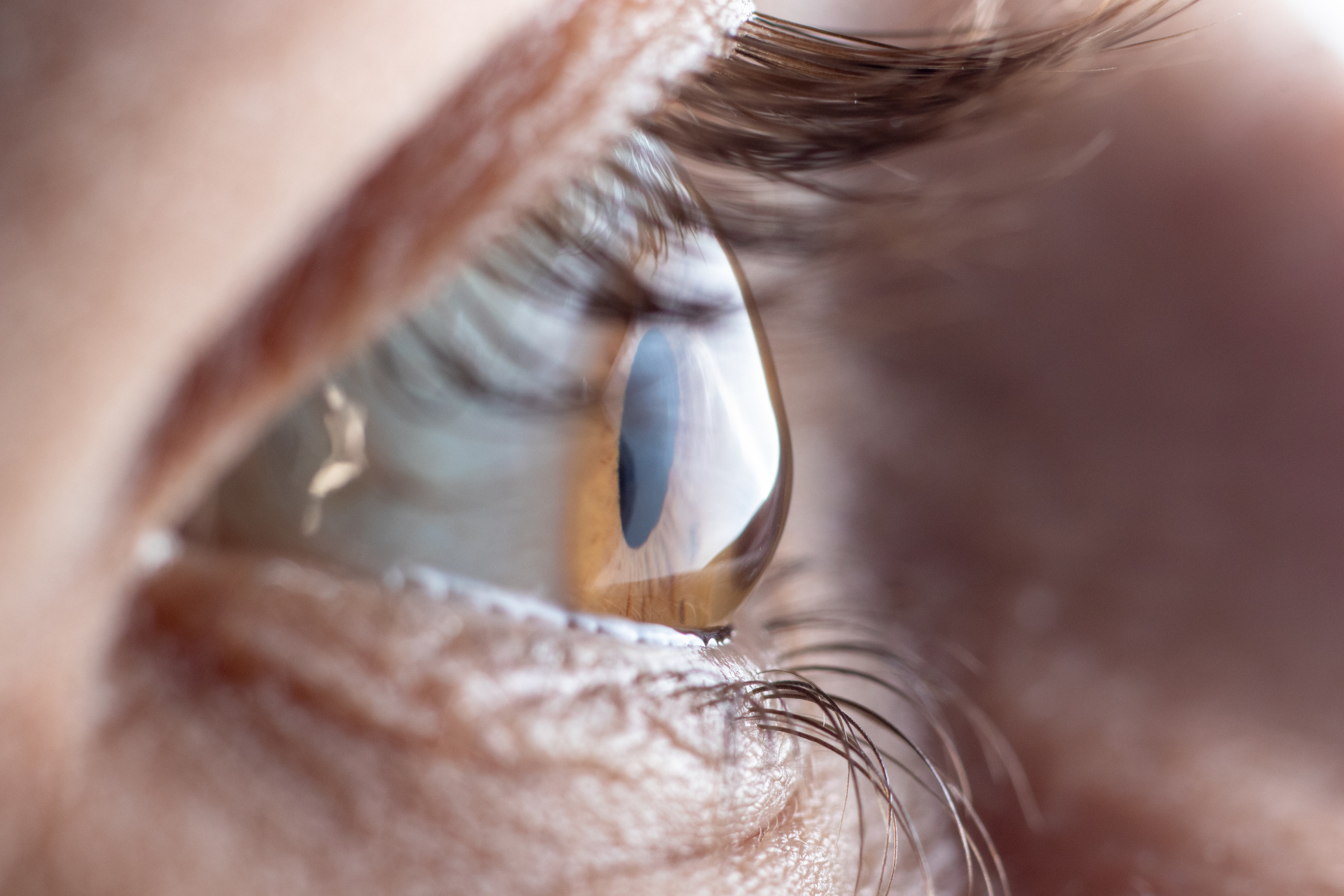 ¿Se puede operar el astigmatismo?