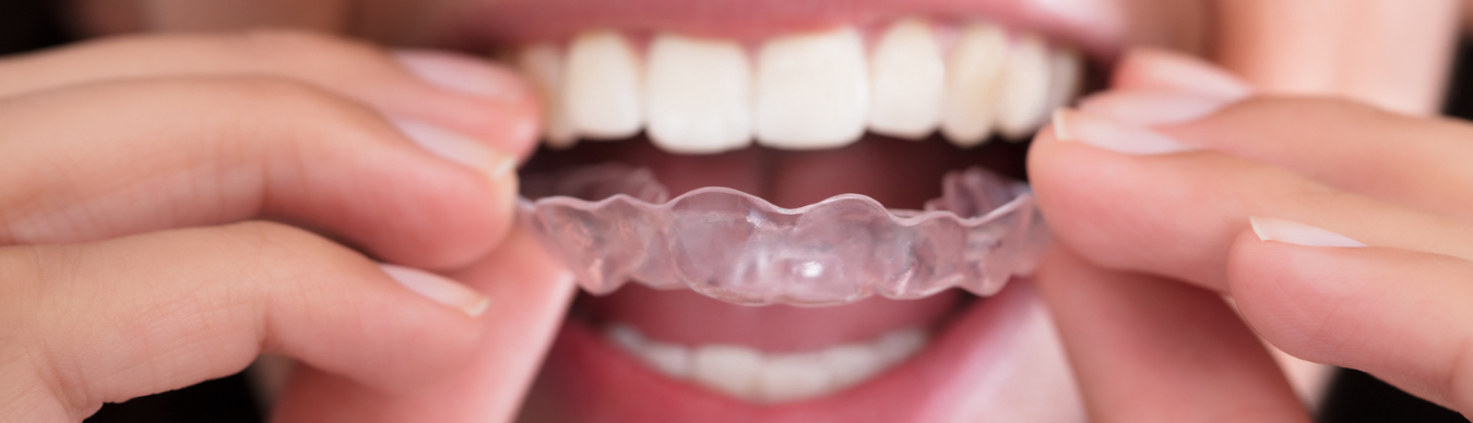 Bruxismo: Causas, Síntomas y Tratamiento