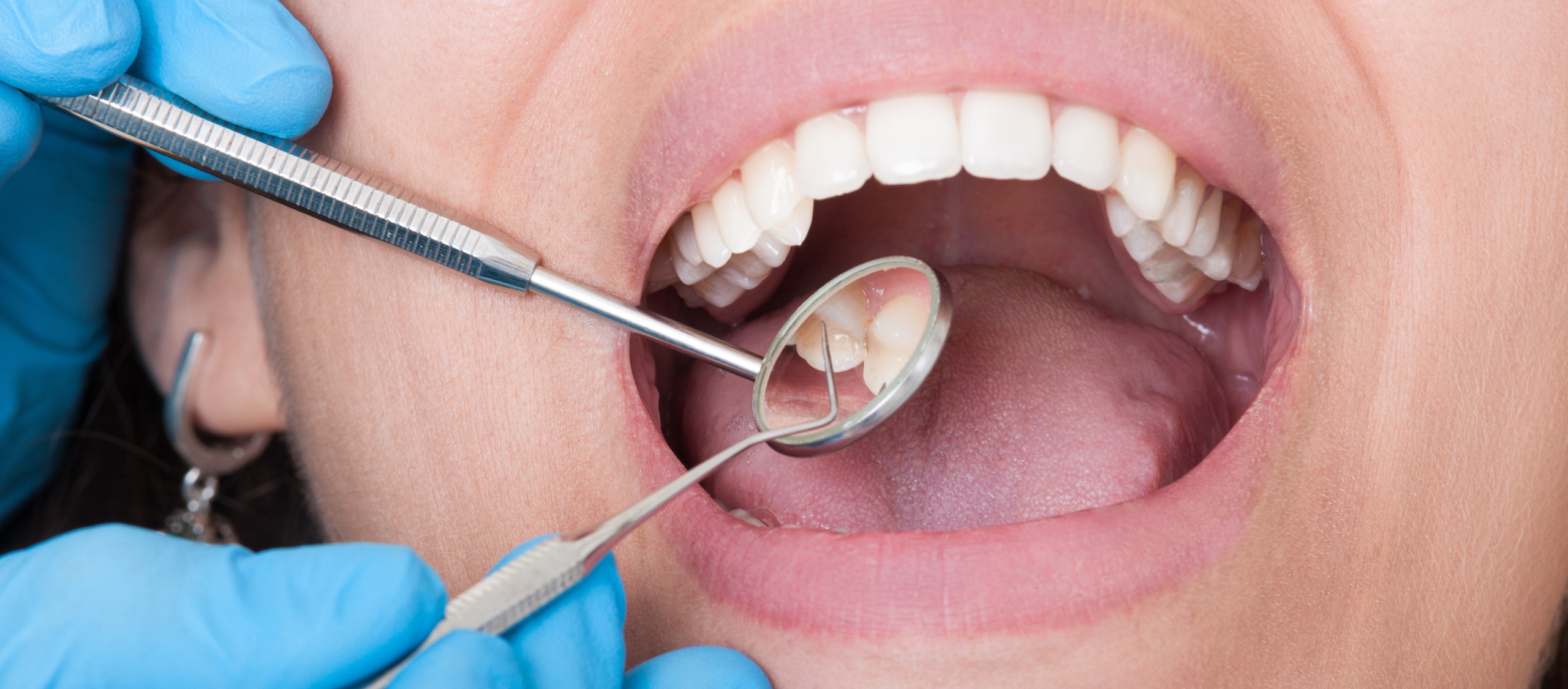 Caries dentales: Tipos y Clases