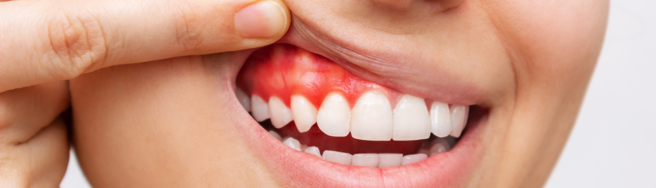 Encías inflamadas, ¿Qué son?