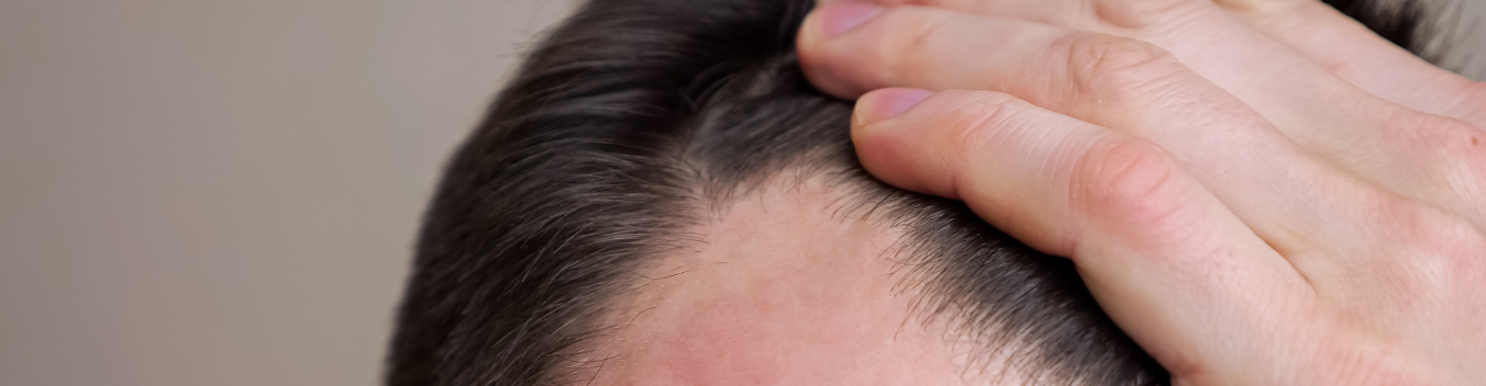 Tipos de entradas en el pelo