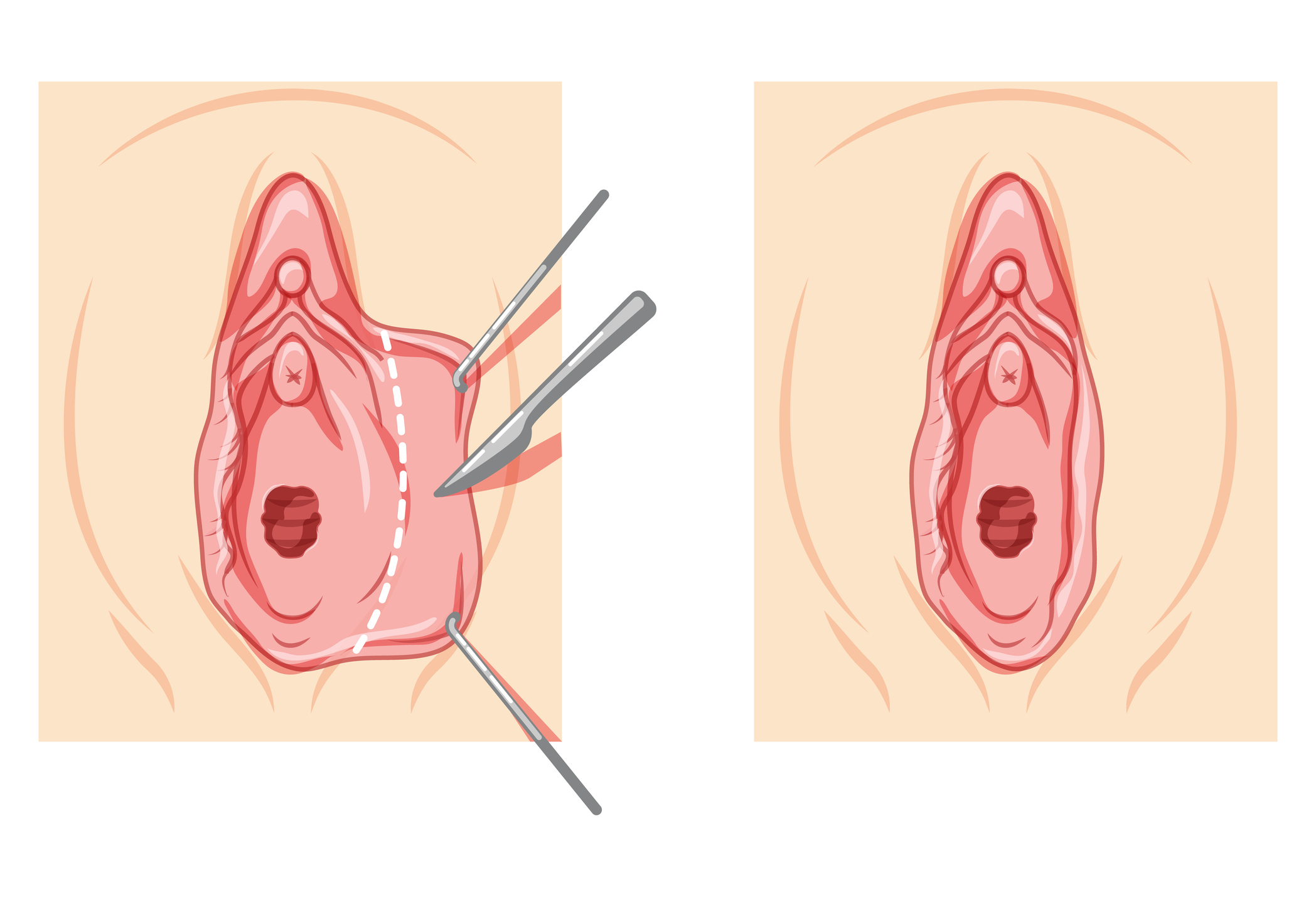 Labioplastia