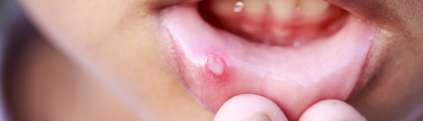 Llagas en la boca, ¿Cuáles son las razones por las que aparecen?