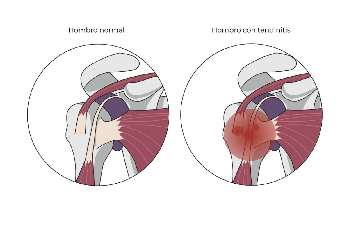 Calcificación Hombro tratamiento para la tendinitis | Viamed Salud
