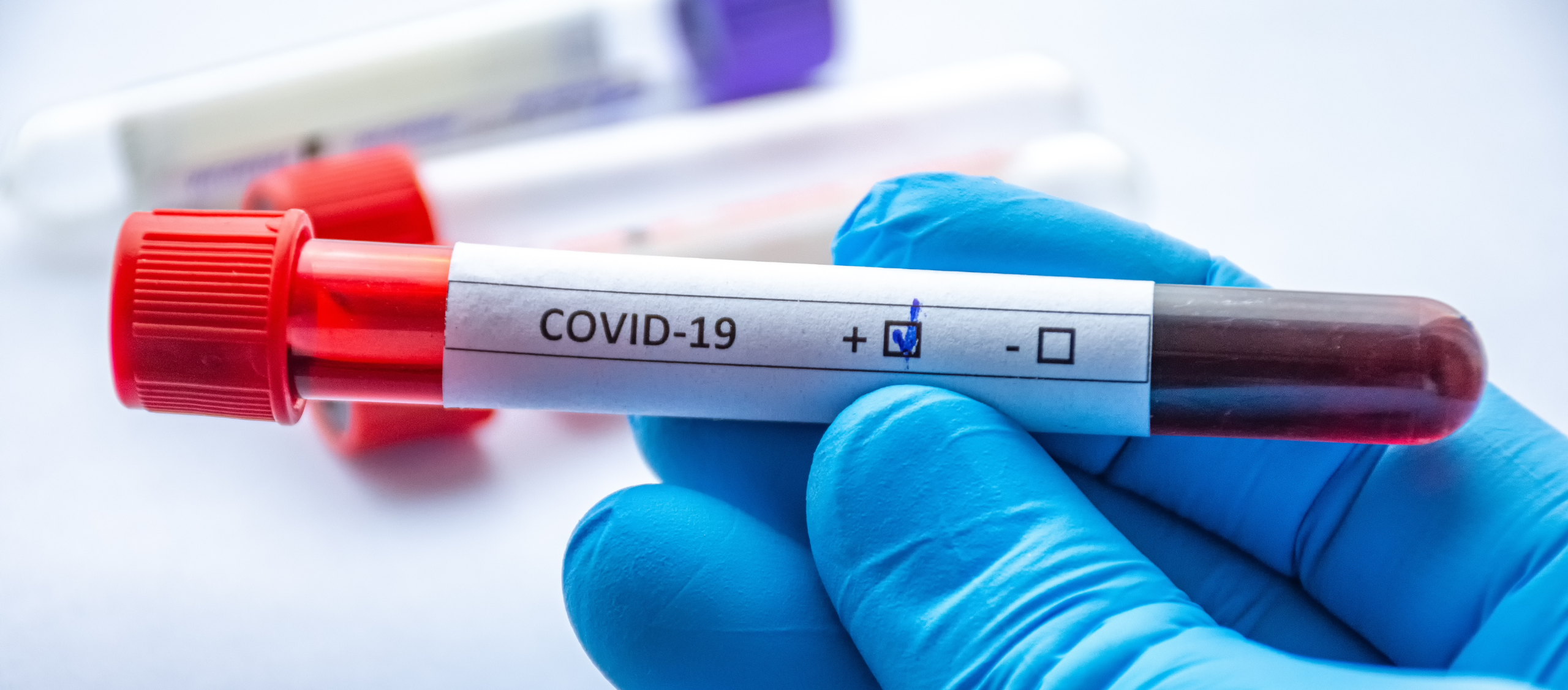 ¿Cómo diagnosticar el COVID-19? Análisis Serología