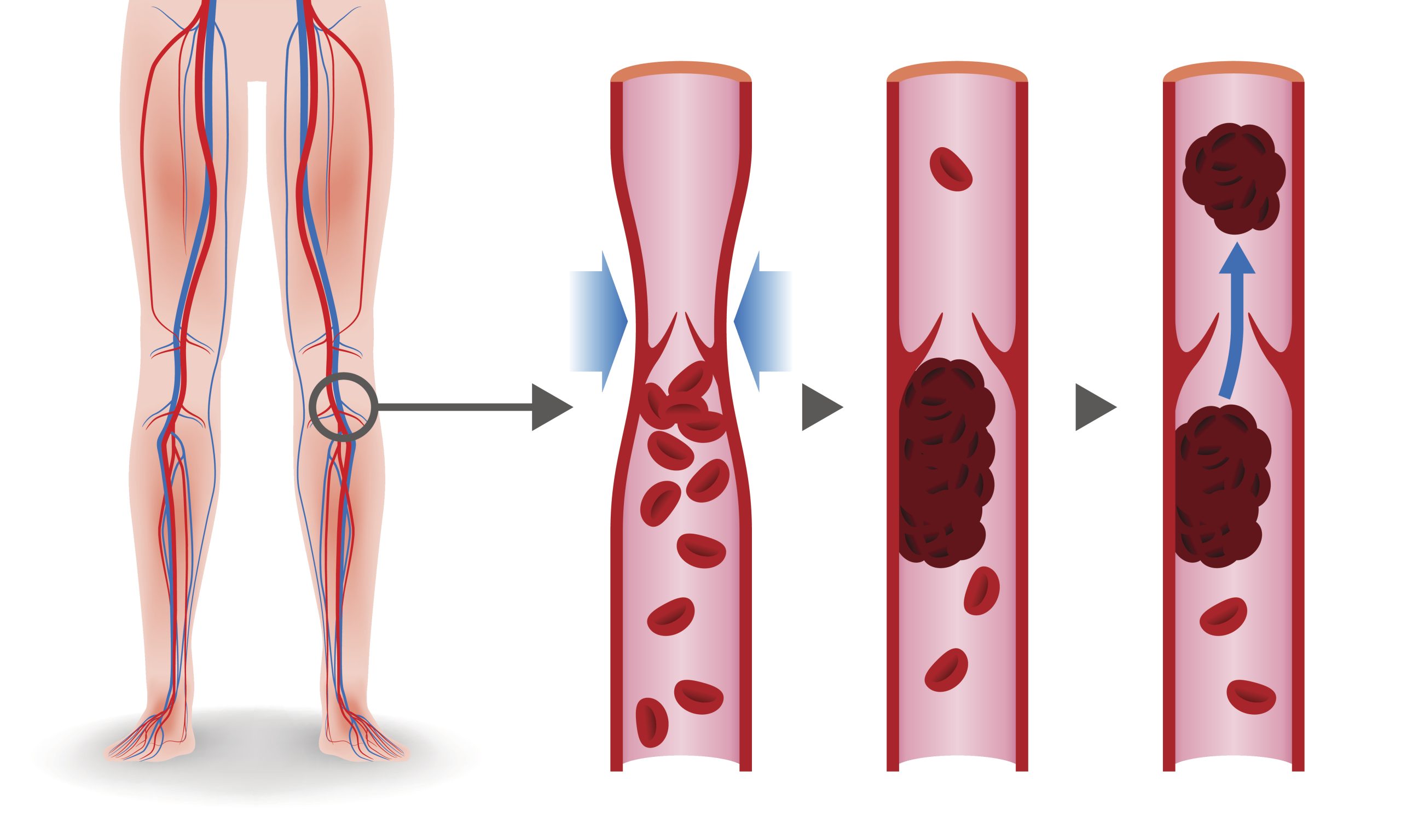 Representación gráfica de una trombosis en la pierna.
