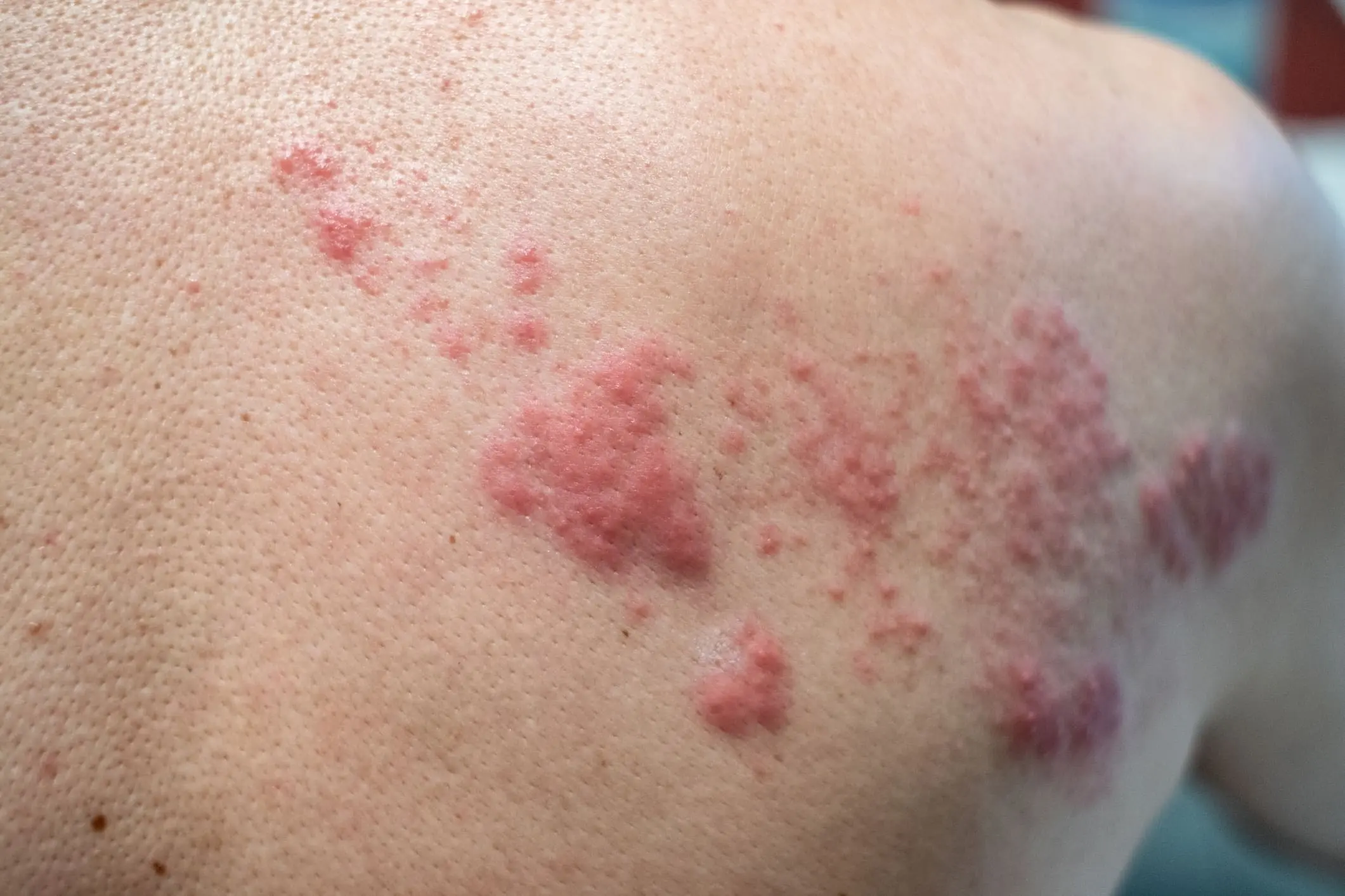 Herpes Zóster: Causas, Diagnóstico y Tratamiento