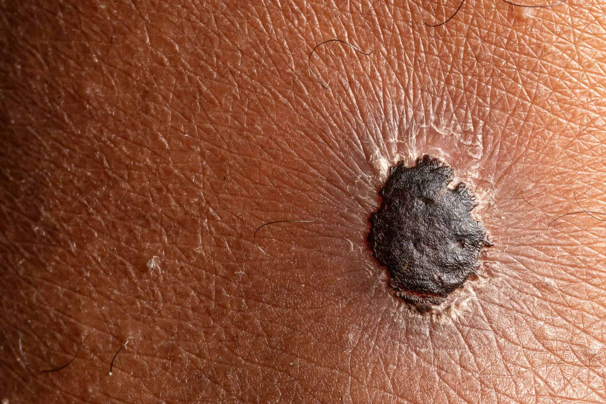 ¿Cuánto tarda un melanoma en hacer metástasis?