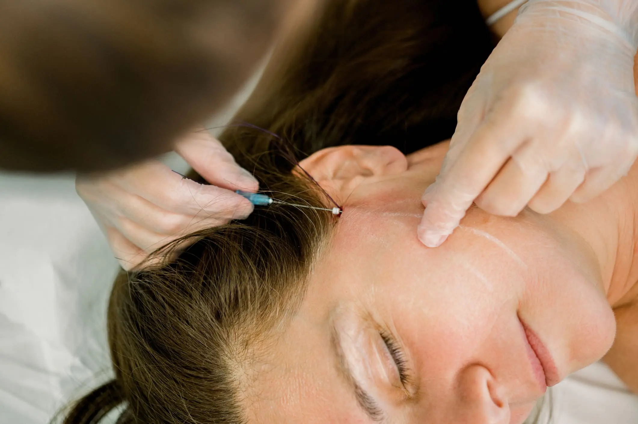 Hilos tensores faciales: cómo funcionan y cuándo están indicados